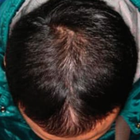 Compare Before & After Photos of _procedure_photos.phpStem Cell Therapy