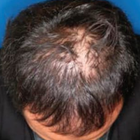 Compare Before & After Photos of _procedure_photos.phpStem Cell Therapy