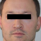 Compare Before & After Photos of _procedure_photos.phpSeptoplasty