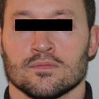 Compare Before & After Photos of _procedure_photos.phpSeptoplasty