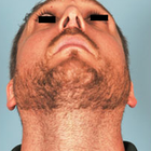 Compare Before & After Photos of _procedure_photos.phpSeptoplasty