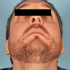 Compare Before & After Photos of _procedure_photos.phpSeptoplasty