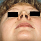 Compare Before & After Photos of _procedure_photos.phpSeptoplasty