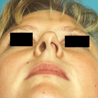 Compare Before & After Photos of _procedure_photos.phpSeptoplasty