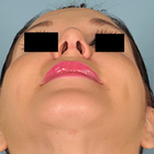 Compare Before & After Photos of _procedure_photos.phpSeptoplasty