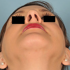 Compare Before & After Photos of _procedure_photos.phpSeptoplasty