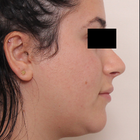 Compare Before & After Photos of _procedure_photos.phpSeptoplasty