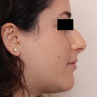 Compare Before & After Photos of _procedure_photos.phpSeptoplasty