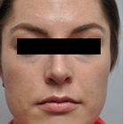 Compare Before & After Photos of _procedure_photos.phpSeptoplasty