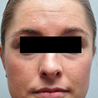 Compare Before & After Photos of _procedure_photos.phpSeptoplasty