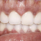 Compare Before & After Photos of _procedure_photos.phpInvisalign