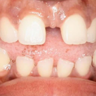Compare Before & After Photos of _procedure_photos.phpInvisalign