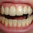 Compare Before & After Photos of _procedure_photos.phpInvisalign