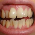 Compare Before & After Photos of _procedure_photos.phpInvisalign