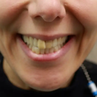 Compare Before & After Photos of _procedure_photos.phpInvisalign