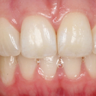 Compare Before & After Photos of _procedure_photos.phpInvisalign