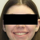 Compare Before & After Photos of _procedure_photos.phpInvisalign