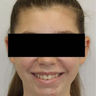 Compare Before & After Photos of _procedure_photos.phpInvisalign