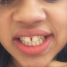 Compare Before & After Photos of _procedure_photos.phpBraces