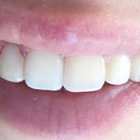 Compare Before & After Photos of _procedure_photos.phpBraces