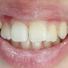 Compare Before & After Photos of _procedure_photos.phpBraces