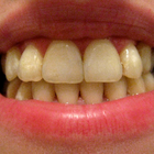 Compare Before & After Photos of _procedure_photos.phpBraces