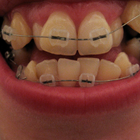 Compare Before & After Photos of _procedure_photos.phpBraces