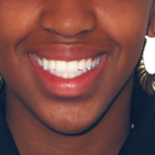 Compare Before & After Photos of _procedure_photos.phpBraces