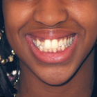 Compare Before & After Photos of _procedure_photos.phpBraces