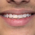 Compare Before & After Photos of _procedure_photos.phpBraces