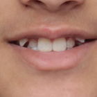 Compare Before & After Photos of _procedure_photos.phpBraces