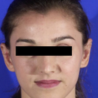 Compare Before & After Photos of _procedure_photos.phpOtoplasty