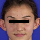 Compare Before & After Photos of _procedure_photos.phpOtoplasty