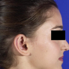 Compare Before & After Photos of _procedure_photos.phpOtoplasty