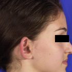 Compare Before & After Photos of _procedure_photos.phpOtoplasty
