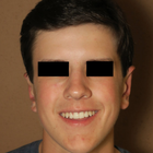 Compare Before & After Photos of _procedure_photos.phpOtoplasty