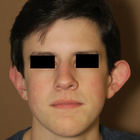 Compare Before & After Photos of _procedure_photos.phpOtoplasty