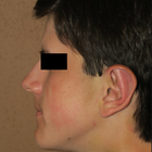 Compare Before & After Photos of _procedure_photos.phpOtoplasty