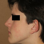 Compare Before & After Photos of _procedure_photos.phpOtoplasty