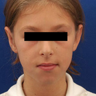 Compare Before & After Photos of _procedure_photos.phpOtoplasty