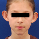 Compare Before & After Photos of _procedure_photos.phpOtoplasty