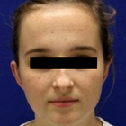 Compare Before & After Photos of _procedure_photos.phpOtoplasty