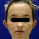 Compare Before & After Photos of _procedure_photos.phpOtoplasty