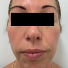 Compare Before & After Photos of _procedure_photos.phpHigh-Intensity Focused Ultrasound (HIFU)