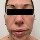 Compare Before & After Photos of _procedure_photos.phpHigh-Intensity Focused Ultrasound (HIFU)