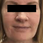 Compare Before & After Photos of _procedure_photos.phpHigh-Intensity Focused Ultrasound (HIFU)