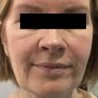 Compare Before & After Photos of _procedure_photos.phpHigh-Intensity Focused Ultrasound (HIFU)