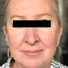 Compare Before & After Photos of _procedure_photos.phpHigh-Intensity Focused Ultrasound (HIFU)