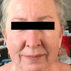 Compare Before & After Photos of _procedure_photos.phpHigh-Intensity Focused Ultrasound (HIFU)