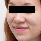 Compare Before & After Photos of _procedure_photos.phpHigh-Intensity Focused Ultrasound (HIFU)